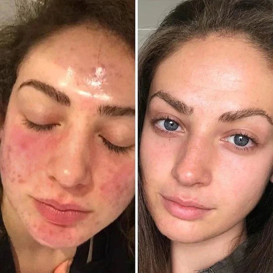 Brightens skin tone Turmeric & Kojic Acid Pads 40 Pads